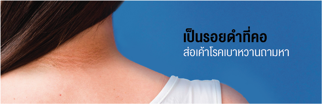 Dark patches on the neck, a sign of diabetes