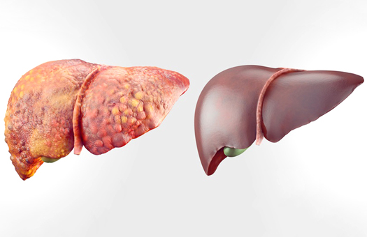 Liver detoxification treatment